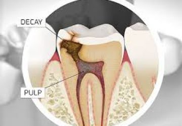 root canal 4